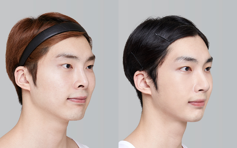 FACIAL CONTOURING (CHEEKBONE REDUCTION+JAW ANGLE REDUCTION+GENIOPLASTY) before and 6 months after - 45-degree view