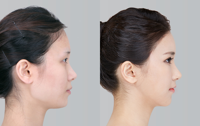 FACIAL CONTOURING (CHEEKBONE REDUCTION+JAW ANGLE REDUCTION+GENIOPLASTY) before and 6 months after - profile view