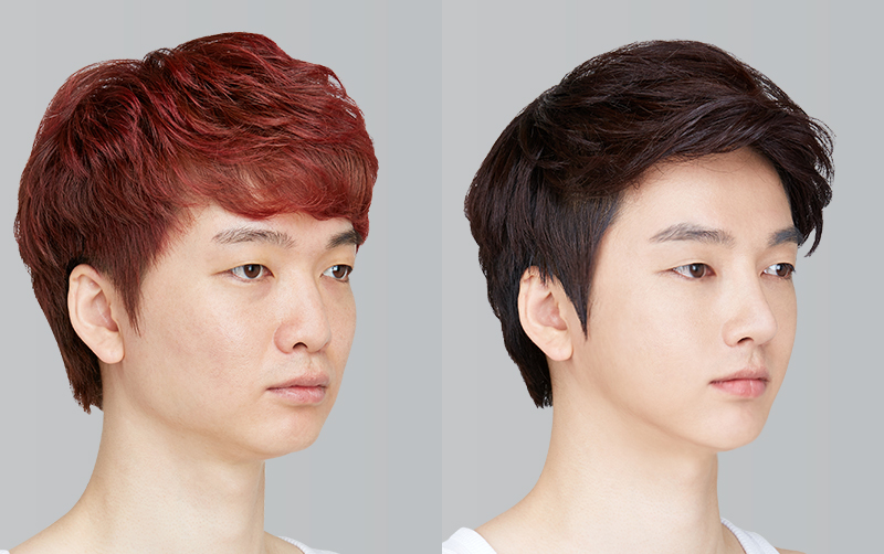 FACIAL CONTOURING (CHEEKBONE REDUCTION+JAW ANGLE REDUCTION+GENIOPLASTY) before and 6 months after - 45-degree view