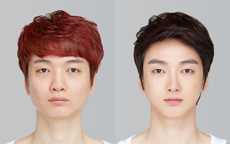 FACIAL CONTOURING (CHEEKBONE REDUCTION+JAW ANGLE REDUCTION+GENIOPLASTY) before and 6 months after - front view