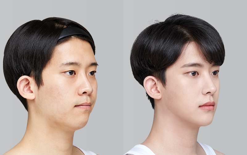 FACIAL CONTOURING (CHEEKBONE REDUCTION+JAW ANGLE REDUCTION+GENIOPLASTY) before and 6 months after - 45-degree view