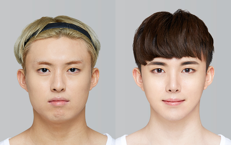 RHINOPLASTY before and 6 months after - front view
