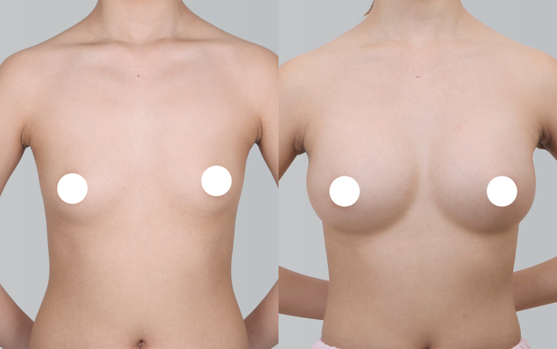 BREAST AUGMENTATION before and 6 months after - front view