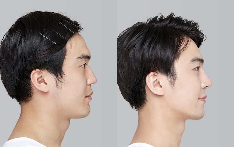 FACIAL CONTOURING (CHEEKBONE REDUCTION+JAW ANGLE REDUCTION+GENIOPLASTY) before and 6 months after - profile view