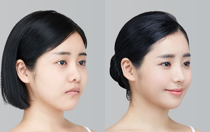 RHINOPLASTY before and 6 months after - 45-degree view
