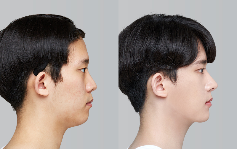 FACIAL CONTOURING (CHEEKBONE REDUCTION+JAW ANGLE REDUCTION+GENIOPLASTY) before and 6 months after - profile view