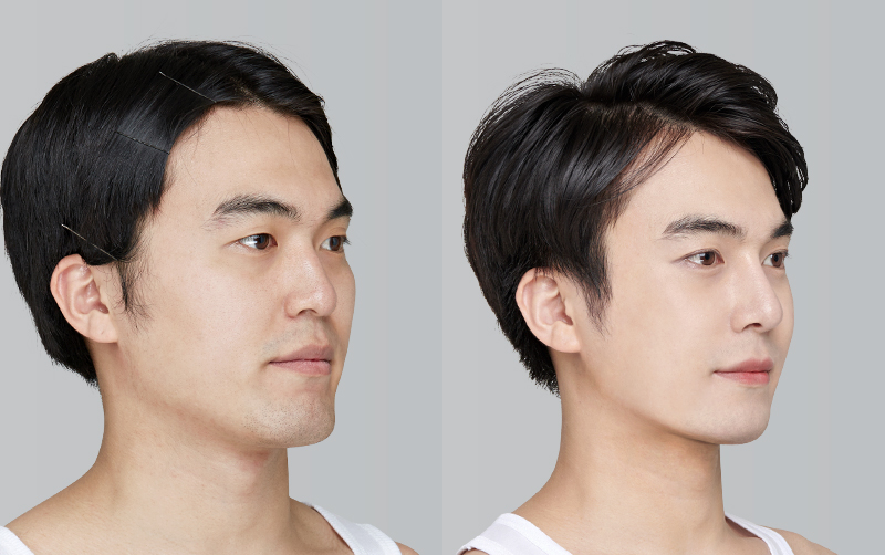 FACIAL CONTOURING (CHEEKBONE REDUCTION+JAW ANGLE REDUCTION+GENIOPLASTY) before and 6 months after - 45-degree view