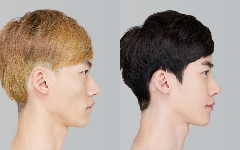 FACIAL CONTOURING (CHEEKBONE REDUCTION+JAW ANGLE REDUCTION+GENIOPLASTY) before and 6 months after - profile view