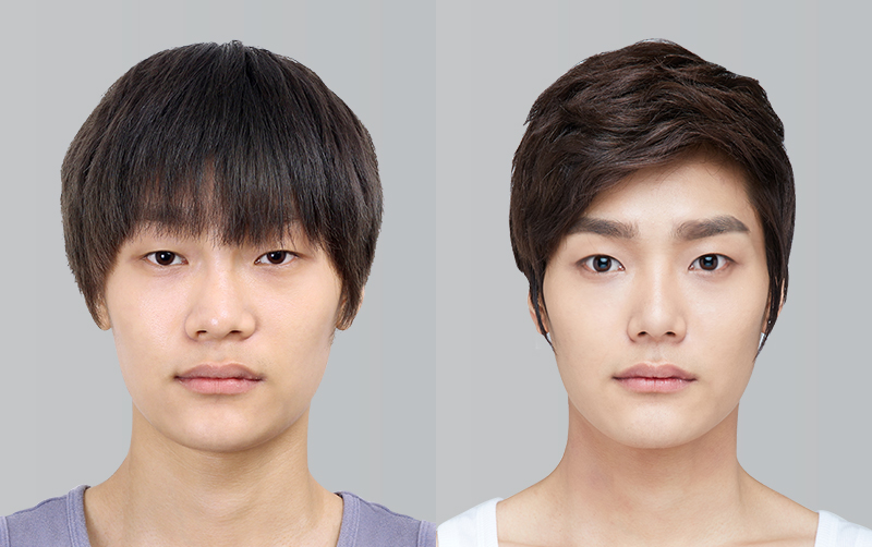 RHINOPLASTY before and 6 months after - front view