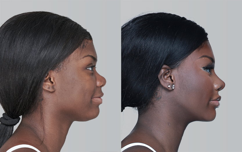 FACIAL CONTOURING (CHEEKBONE REDUCTION+JAW ANGLE REDUCTION+GENIOPLASTY)+SUNKEEN CHEEK CORRECTION before and 6 months after - profile view