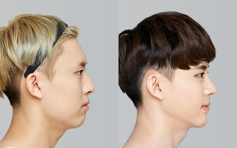RHINOPLASTY before and 6 months after - profile view