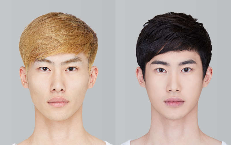FACIAL CONTOURING (CHEEKBONE REDUCTION+JAW ANGLE REDUCTION+GENIOPLASTY) before and 6 months after - front view