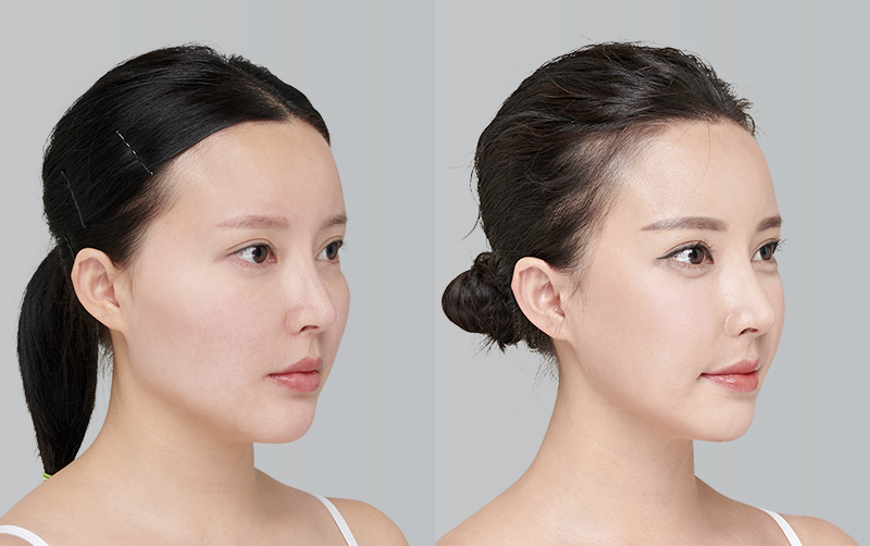 FACIAL CONTOURING (CHEEKBONE REDUCTION+JAW ANGLE REDUCTION) before and 6 months after - 45-degree view