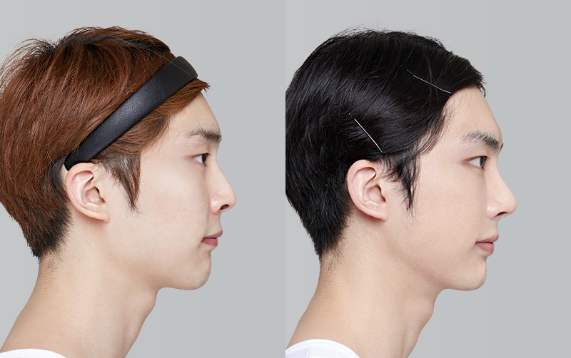 FACIAL CONTOURING (CHEEKBONE REDUCTION+JAW ANGLE REDUCTION+GENIOPLASTY) before and 6 months after - profile view