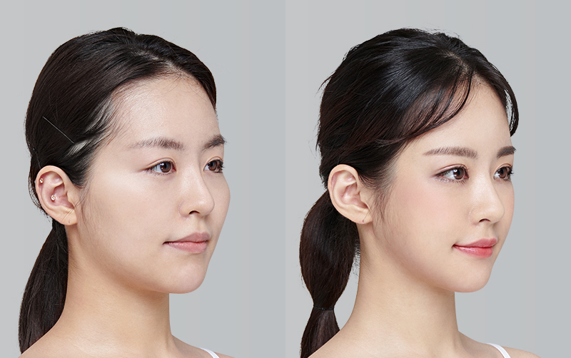 NON-INCISIONAL DOUBLE EYELID SURGERY before and 6 months after - 45-degree view