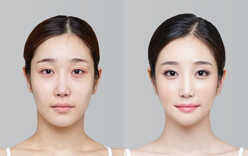 FACIAL CONTOURING (CHEEKBONE REDUCTION+JAW ANGLE REDUCTION+GENIOPLASTY) before and 6 months after - front view