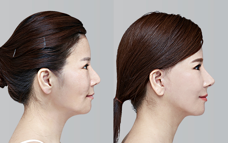 NON-INCISIONAL DOUBLE EYELID SURGERY before and 6 months after - profile view