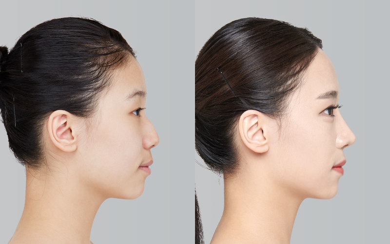RHINOPLASTY before and 6 months after - profile view