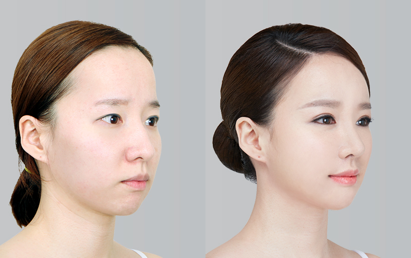 FACIAL CONTOURING (CHEEKBONE REDUCTION+JAW ANGLE REDUCTION+GENIOPLASTY) before and 6 months after - 45-degree view