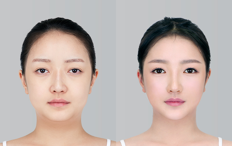 FACIAL CONTOURING (CHEEKBONE REDUCTION+JAW ANGLE REDUCTION+GENIOPLASTY) before and 6 months after - front view