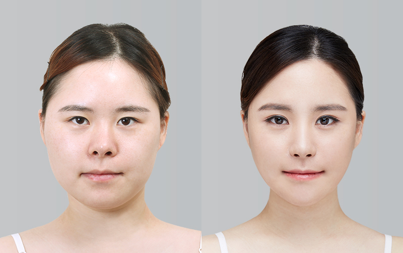 LATERAL CANTHOPLASTY+INCISIONAL DOUBLE EYELID SURGERY+PTOSIS CORRECTION before and 6 months after - front view