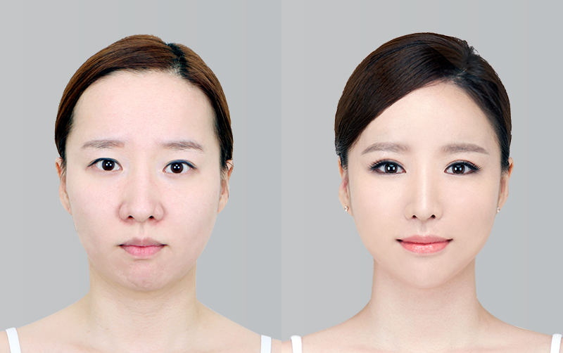 FACIAL CONTOURING (CHEEKBONE REDUCTION+JAW ANGLE REDUCTION+GENIOPLASTY) before and 6 months after - front view