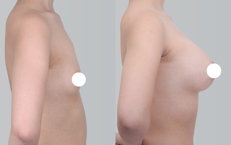 BREAST AUGMENTATION before and 6 months after - profile view