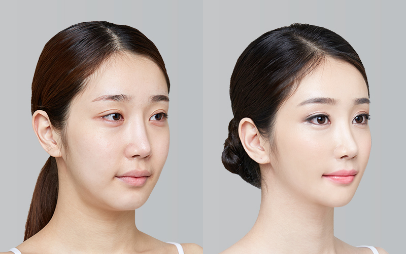 FACIAL CONTOURING (CHEEKBONE REDUCTION+JAW ANGLE REDUCTION+GENIOPLASTY) before and 6 months after - 45-degree view