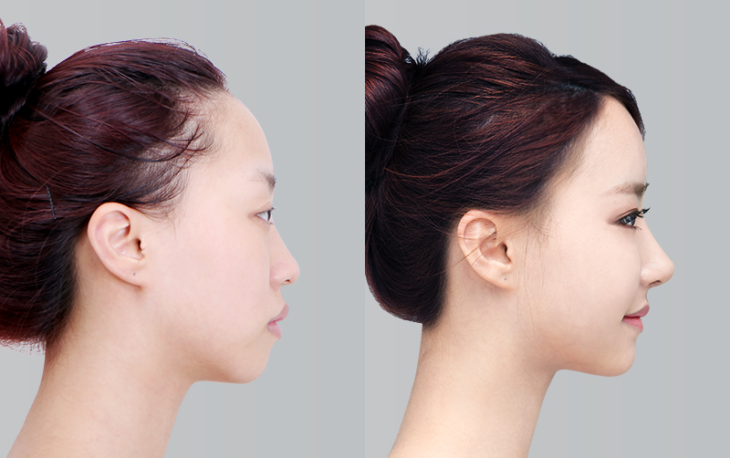 RHINOPLASTY before and 6 months after - profile view