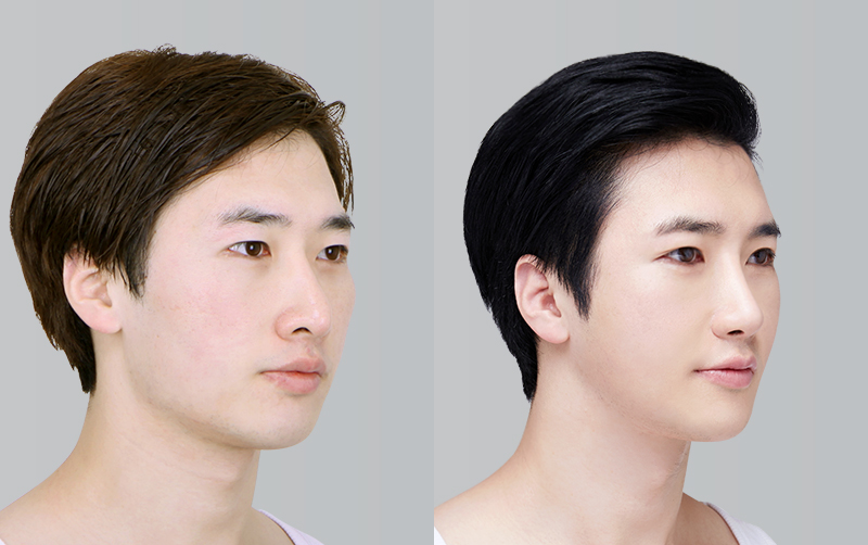 RHINOPLASTY before and 6 months after - 45-degree view