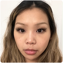 Before surgery: front-view photograph in the recovery timeline.