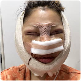 Day 1: front-view photograph with postoperative dressings and a facial band.