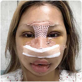 Day 5: front-view photograph with postoperative dressings.