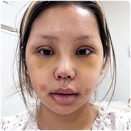 Day 7: front-view recovery photograph.