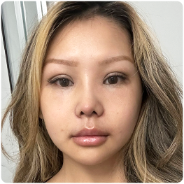 One month: front-view recovery photograph.