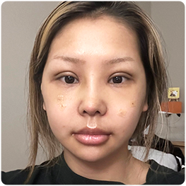 Two weeks: front-view recovery photograph.