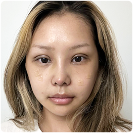 Three weeks: front-view recovery photograph.