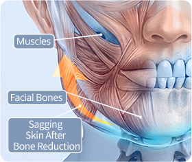 Facial anatomy illustration showing muscles, facial bones, and skin sagging following bone reduction.