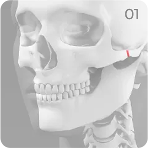 Cheekbone reduction step 1 showing the lateral cheekbone osteotomy