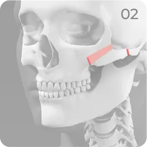 Cheekbone reduction step 2 showing removal of the inner frontal cheekbone