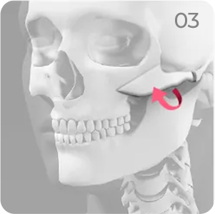 Cheekbone reduction step 3 showing repositioning of the cheekbone