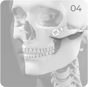 Cheekbone reduction step 4 showing fixation with plates and screws