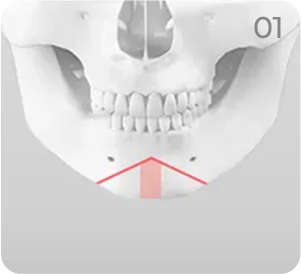 Genioplasty step 1 showing an inverted V-shaped chin osteotomy