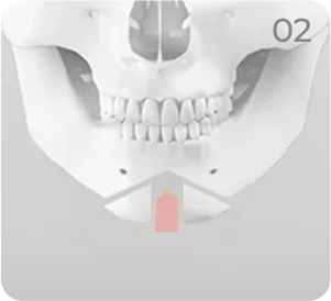 Genioplasty step 2 showing removal of the middle chin bone segment