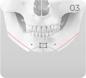 Genioplasty step 3 showing repositioned chin segments secured with a plate