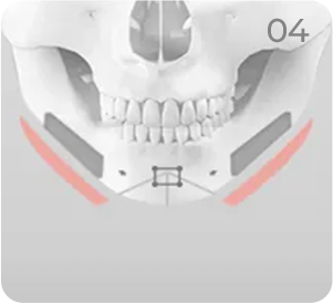 Genioplasty step 4 showing square jaw resection and cortical bone shaving