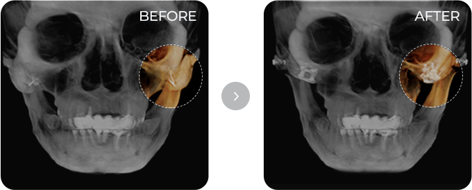 Before-and-after CT comparison following revision facial contouring