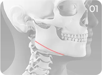 Square jaw reduction step 1 showing mandibular angle resection
