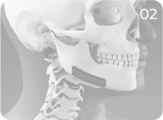 Square jaw reduction step 2 showing lateral cortical bone shaving