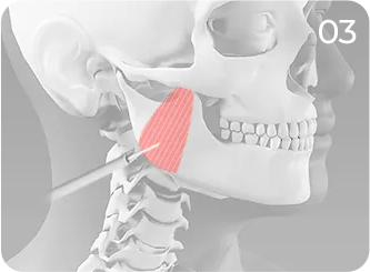 Square jaw reduction step 3 showing masseter muscle reduction
